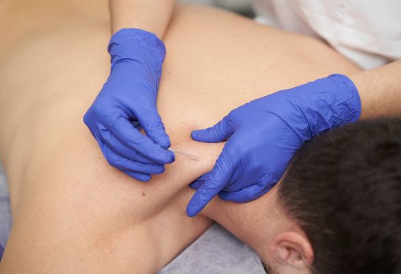 dry-needling-fysiotherapie-rvgf