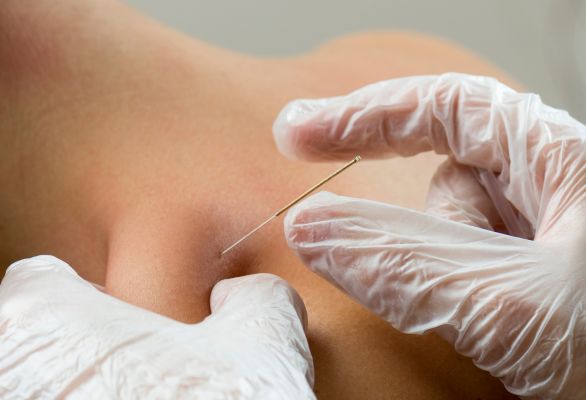 dry-needling-fysiotherapie